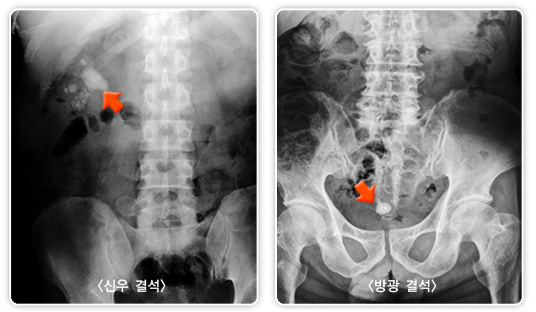 산통 맞먹는 요로결석 심해지는 여름···이것 보충해라