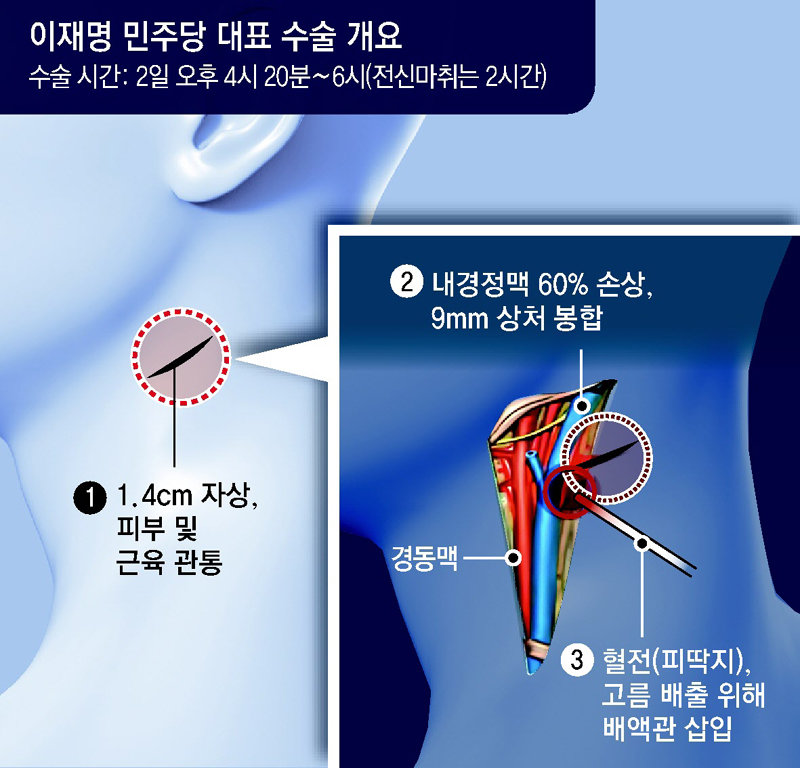이재명 집도의 “1.4cm 자상… 어려운 수술이라 서울이송 수용”