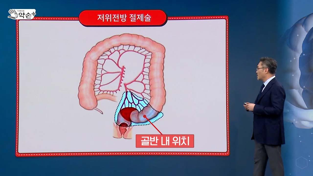 [약손+] 건강 대변 몸속 대장 지켜라 '대장암' ⑬까다로운 직장암