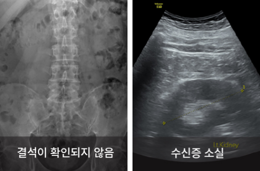 요관 내시경 결석 제거술, 꼭 해야 하는 경우는? [아는만큼 젊어지는 비뇨기 질환 이야기]