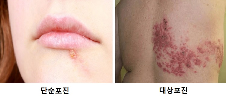 대상포진과 착각하기 쉬운 단순포진 “원인은 헤르페스 바이러스” 최고의 예방법은? | 이앤투어픽