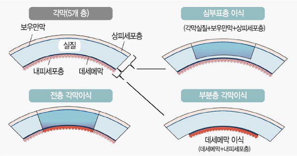 각막 ‘전체 이식’보다 장점 많은 ‘부분 이식’…시력회복 만족도 높다