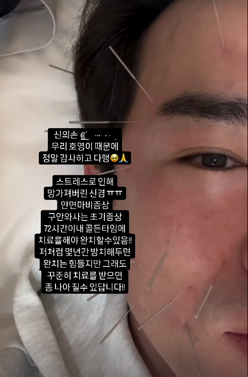 안면가스 이미지