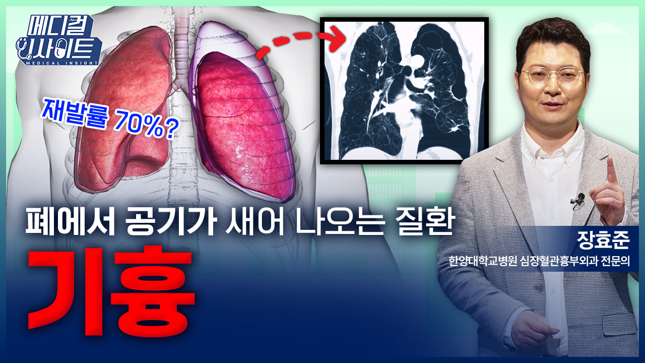 [메디컬 인사이트 108회] 흉부외과 전문의가 알려주는 '기흉의 증상과 치료법'
