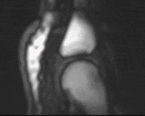 손가락 관절에서 거품이 형성되는 순간. Science Editor 유튜브, 2015,  ‘Actually SEE the Bubble when a Joint Makes a Cracking Noise’ 캡처.