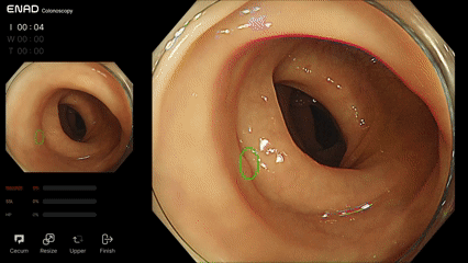 아이넥스 '에나드'를 활용한 대장내시경 진단 영상. 녹색으로 병변 부위가 실시간으로 표시되고 있다./사진=아이넥스