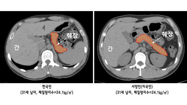 이 세상의 모든 것 모아모아 | 동양인 서양인 췌장 크기 비교 - Daum 카페