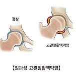 일과성 고관절 활액막염