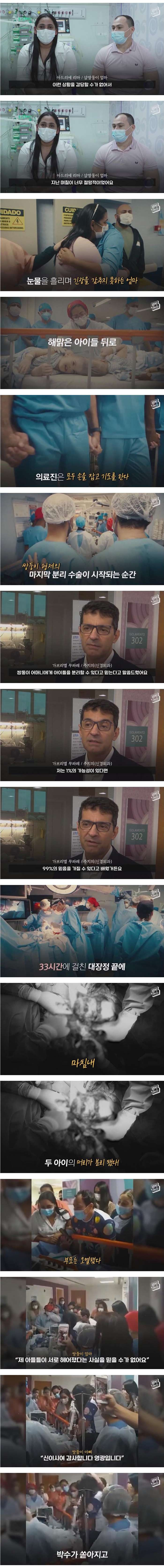 33시간 수술 끝에 헤어진 쌍둥이