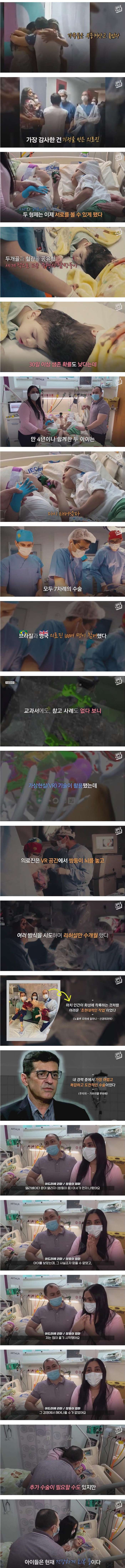 33시간 수술 끝에 헤어진 쌍둥이