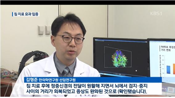 “침 치료로 뇌 구조 변화” 세계 최초 효과 입증