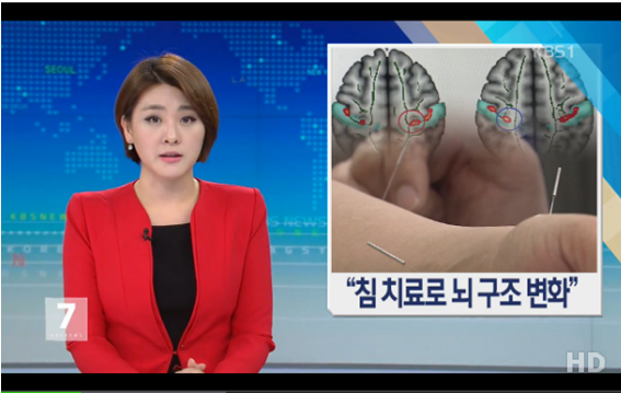 “침 치료로 뇌 구조 변화” 세계 최초 효과 입증