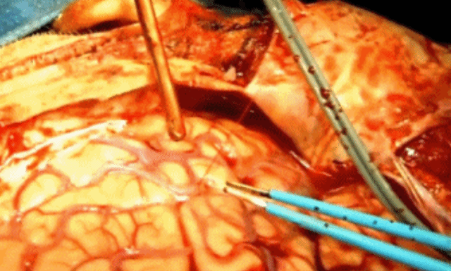 혐) 뇌출혈 수술