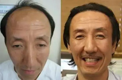 머리 심은 연예인들