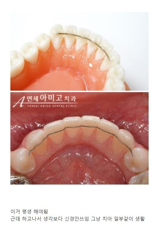  치아교정 전에 이거 모르고 하는 사람 많음