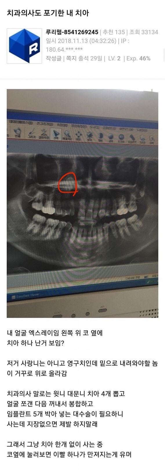  치과의사도 포기한 치아