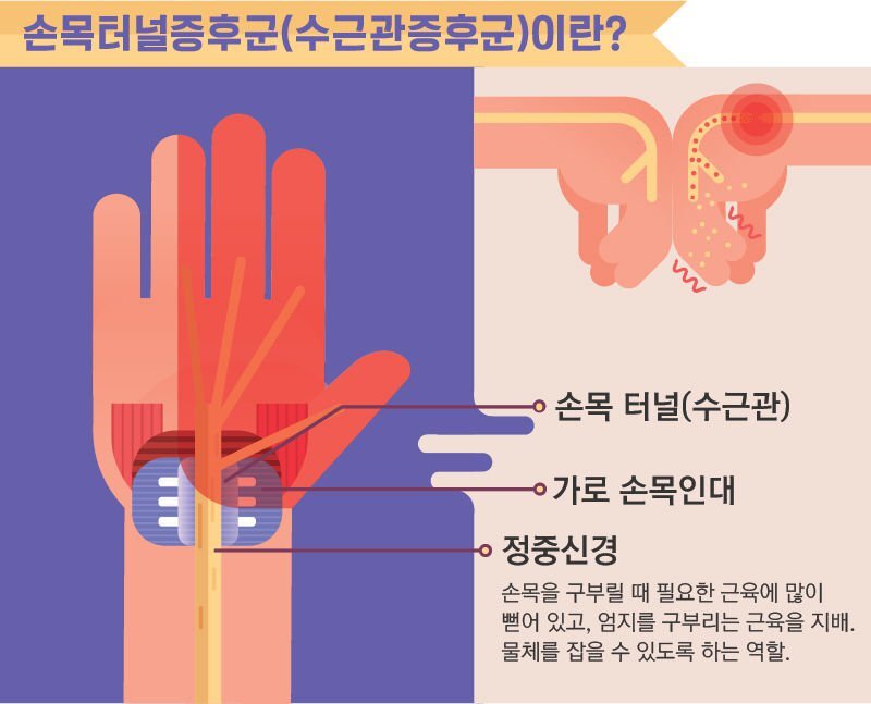 손목 터널 증후군 간단 확인 방법