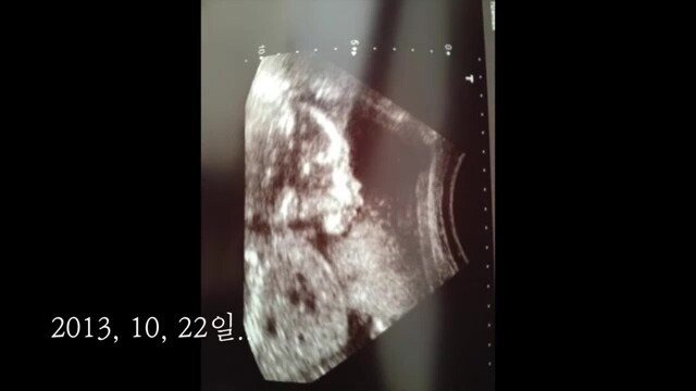 pic_005.jpg 임신 26주차, 미국에서 직장암 판정을 받고 한국에 왔습니다