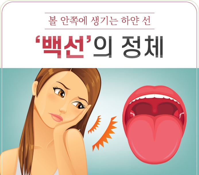 볼 안쪽에 생기는 하얀 선 ‘백선’의 정체