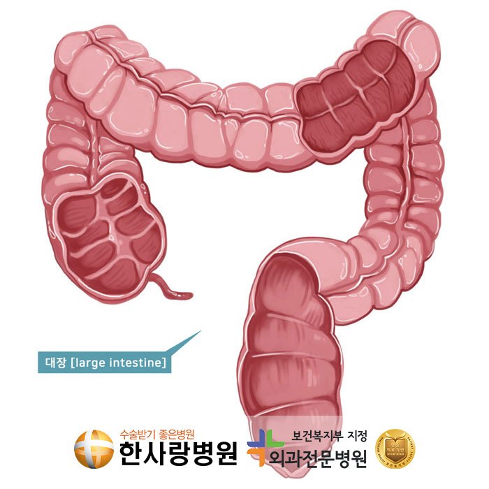 대장 속 주머니, 거기에 염증까지? 대장게실염