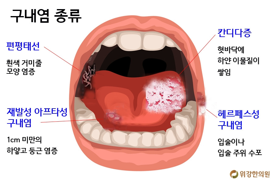입안이허는이유 구내염 종류와 치료법 알아보기