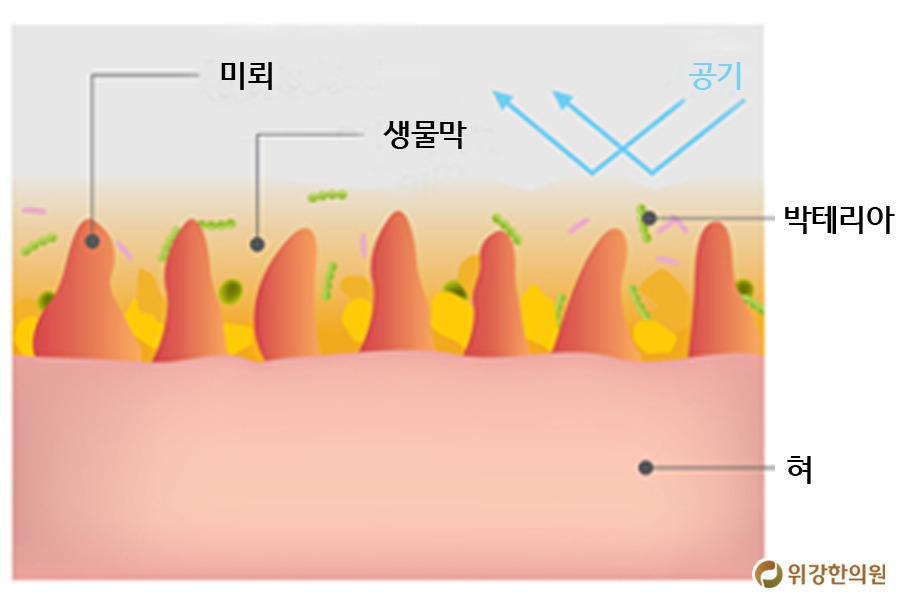 미각상실 구강질환 치료하면 돌아온다!