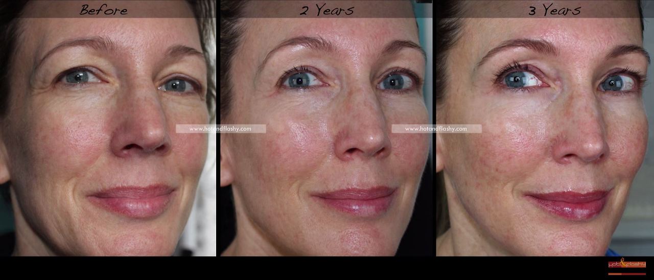 Dermatec beautifying facial peel, fat girls vagina naked mexican girls