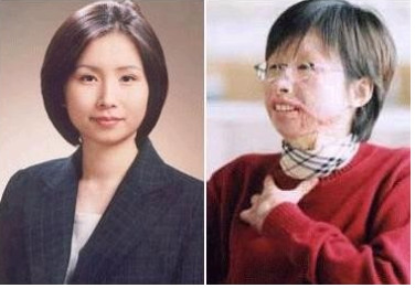 事故前（左）と事故後（右）のイ・チソンさん