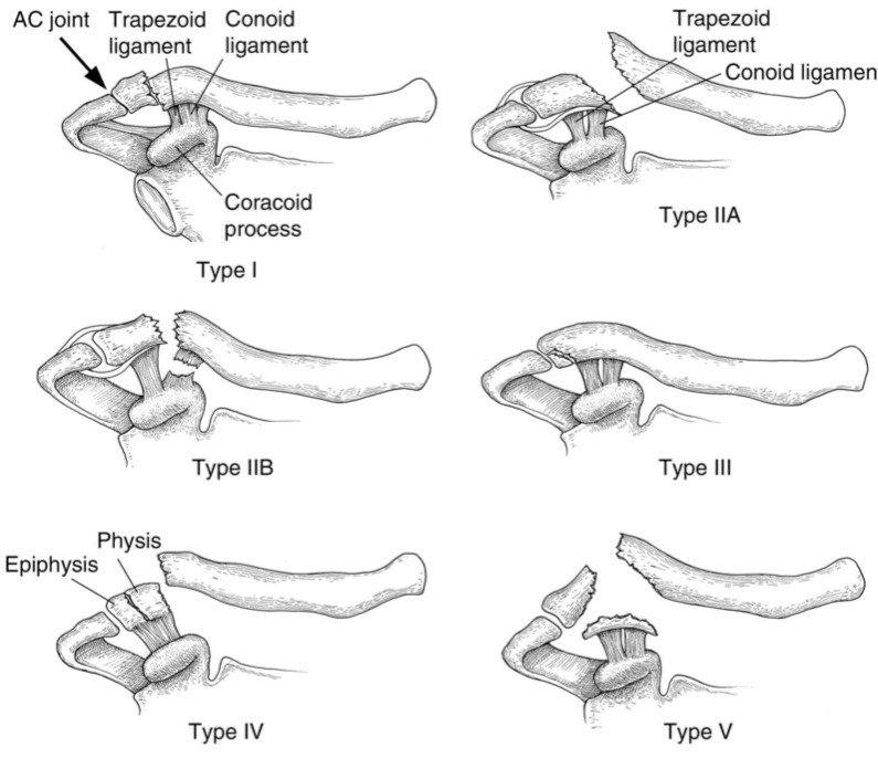 쇄골 원위부 골절 비수술치료로 진행 결정
