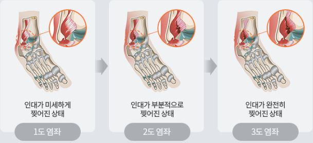 발목이 삐끗, 발목염좌 진단 및 치료법