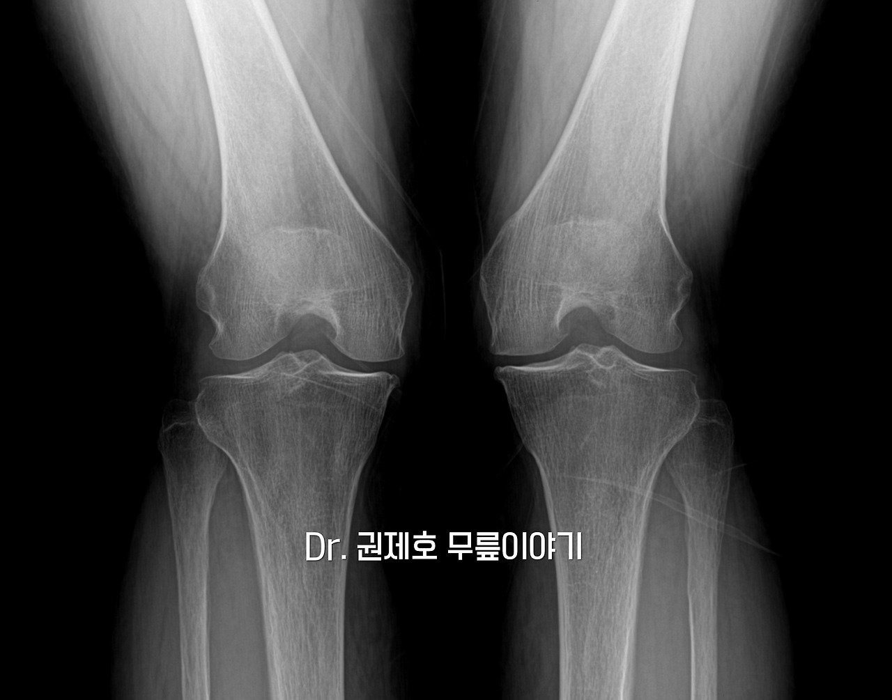 무릎 연골 줄기세포치료