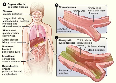 낭포성섬유증(cystic fibrosis)