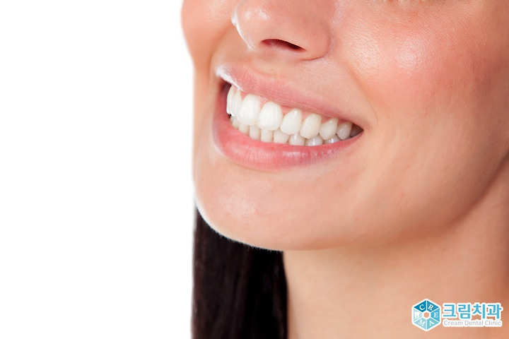 앞니 라미네이트 / 연예인 치아성형 10