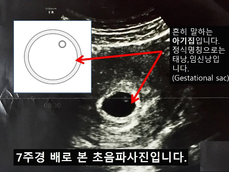 임신 6주차 초음파 검사 후기 심장음 성별궁전 메스꺼움 약 처방 3