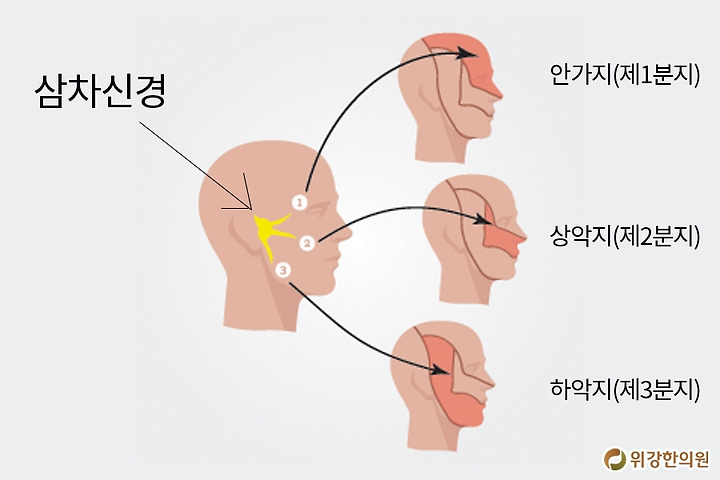 삼차신경통증상 찌릿한 아픔있다면 9