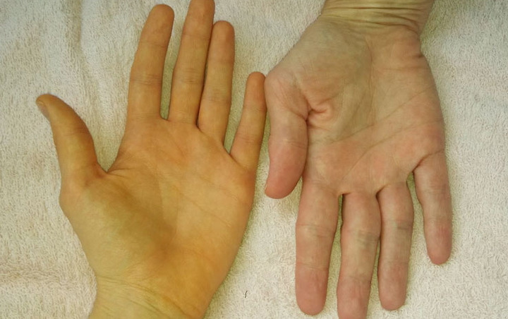 무시해서 더욱 끔찍해지는 췌장암 증상 8가지