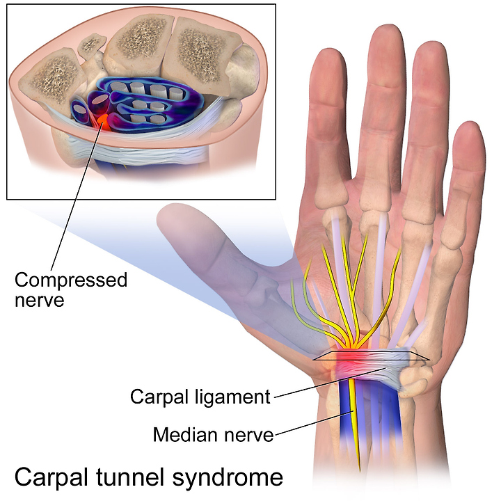 [NCPT] 9. Carpal Tunnel Syndrome / 손목터널증후군