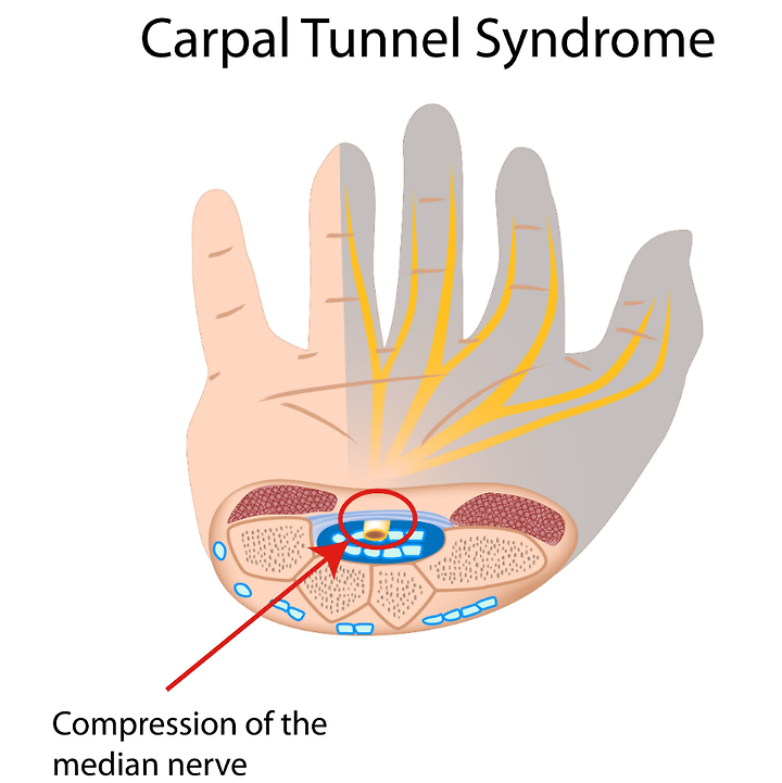 가좌동 손목터널증후군(Carpal Tunnel Syndrome: CTS) case: 밤마다 손끝이 져려요/손목터널수술,손통증[동인천마디정형외과]인천서구 청라동 원창동 석남동 신현동