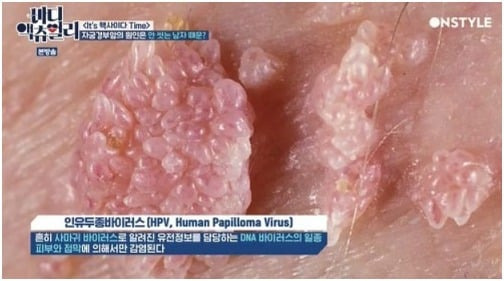 인유두종바이러스.jpg