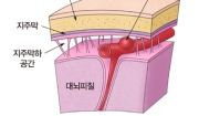 지주막하 출혈