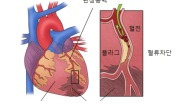 급성 심근경색증