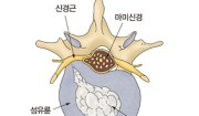 요추 추간판 탈출증