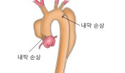 대동맥 박리