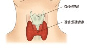 갑상선 기능 저하증