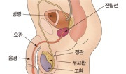 양성 전립선 비대증