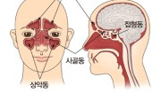 부비동염