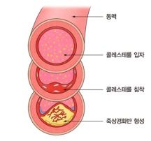 이상지질혈증