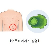 대상포진