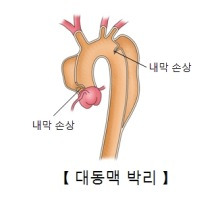 대동맥 박리