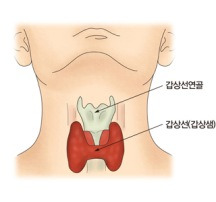 갑상선 기능 저하증